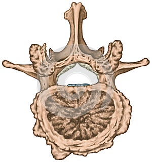 Advanced uncovertebral arthrosis of the second lumbar vertebra