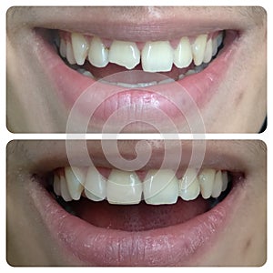 Aesthetic dental restoration