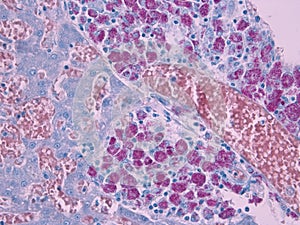 AFB stain for bacilli (red)