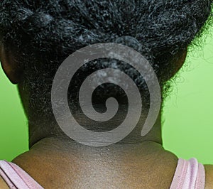 African American female with darkened neck