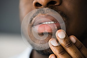 African American Mouth Lip Skin Herpes