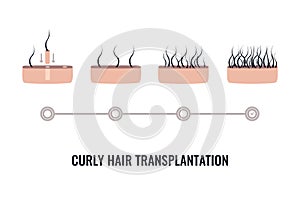 Afro-textured curly hair transplantation surgery result infographics