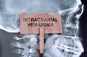 Against the background of an X-ray of the skull, a plate with the inscription - intracranial hematoma