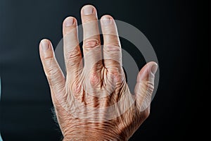 Age related hand discomfort troubles an elderly gentleman