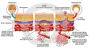 Age related macular degeneration photo