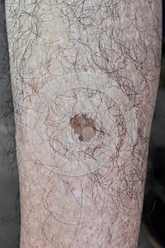 Age spot or nevus on leg with hairy skin of Asian elder man. They are brown, gray, or black spots and called liver spots, senile photo
