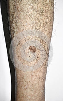 Age spot or nevus on leg with hairy skin of Asian elder man. They are brown, gray, or black spots and called liver spots, senile