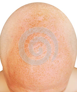 Age spots on the bald head of a man from sunburn