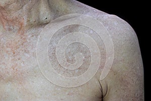 Age spots on body. They are brown, gray, or black spots and also called liver spots, senile lentigo, solar lentigines, or sun photo