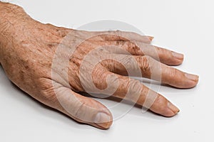 Age spots on hand of Asian elder man. They are brown, gray, or black spots and also called liver spots, senile lentigo, solar