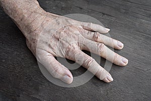 Age spots on hand. They are brown, gray, or black spots and also called liver spots, senile lentigo, solar lentigines, or sun photo