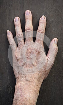 Age spots on hand. They are brown, gray, or black spots and also called liver spots, senile lentigo, solar lentigines, or sun photo