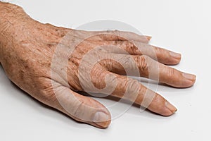 Age spots on hand of Asian elder man. They are brown, gray, or black spots and also called liver spots, senile lentigo, solar photo