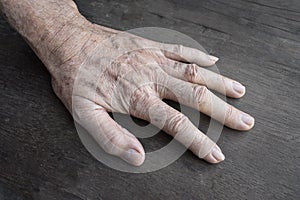 Age spots on hand. They are brown, gray, or black spots and also called liver spots, senile lentigo, solar lentigines, or sun