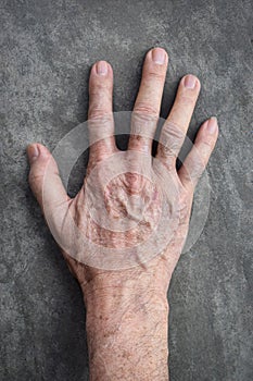 Age spots on hand. They are brown, gray, or black spots and also called liver spots, senile lentigo, solar lentigines, or sun