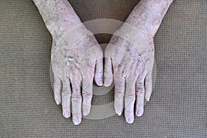 Age spots on hands of Asian elder man. They are brown, gray, or black spots and also called liver spots, senile lentigo, solar photo