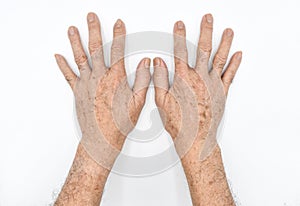 Age spots on hands of Asian elder man. They are brown, gray, or black spots and also called liver spots, senile lentigo, solar