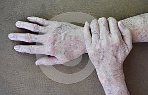 Age spots on hands of Asian elder man. They are brown, gray, or black spots and also called liver spots, senile lentigo, solar
