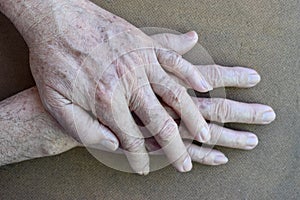 Age spots on hands of Asian elder man. They are brown, gray, or black spots and also called liver spots, senile lentigo, solar photo