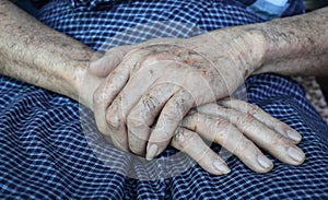 Age spots on hands. They are brown, gray, or black spots and also called liver spots, senile lentigo, solar lentigines, or sun photo