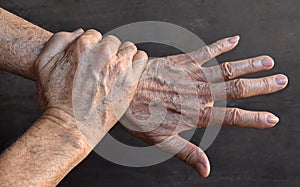 Age spots on hands. They are brown, gray, or black spots and also called liver spots, senile lentigo, solar lentigines, or sun photo