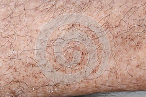 Age spots on the leg. They are brown, gray, or black spots and also called liver spots, senile lentigo, solar lentigines, or sun photo