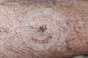 Age spots and scabs on the leg. They are brown, gray, or black spots and also called liver spots, senile lentigo, solar lentigines