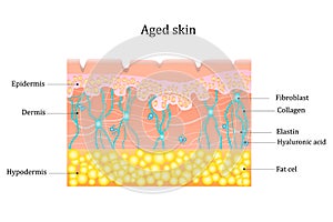 Aged skin layer. Human skin structure with collagen and elastane fibers, hyaluronic acids, fibroblasts. Schematic photo
