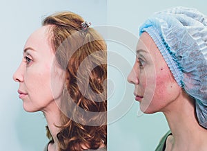 Aged woman doing mesothreads and Thread Lifting, Cosmetology. Cosmetic procedure to eliminate signs of aging. Beauty