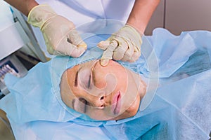 Aged woman doing mesothreads and Thread Lifting, Cosmetology. Cosmetic procedure to eliminate signs of aging. Beauty