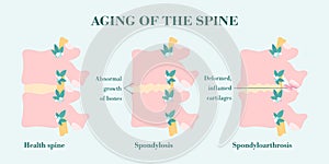 Aging and degeneration of spine columns, patient-friendly diagram