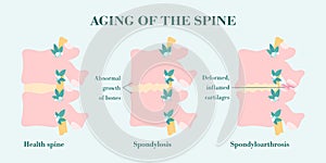Aging and degeneration of spine columns, patient-friendly diagram photo