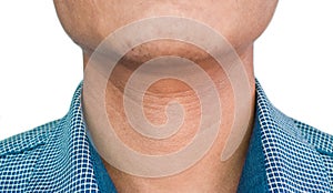 Aging skin folds or creases or wrinkles at neck of Asian young man