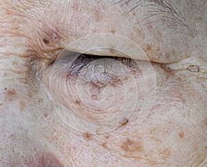 Aging skin folds or skin creases or wrinkles and aging spots at face especially around eye of Southeast Asian, Chinese elderly