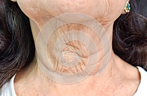 Aging skin folds or skin creases or wrinkles at neck of Asian, Chinese elderly woman