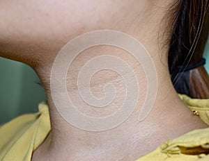 Aging skin folds or skin creases or wrinkles at neck of Southeast Asian, Chinese young woman