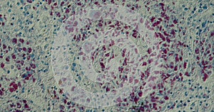 AIDS Mycobacteria tissue