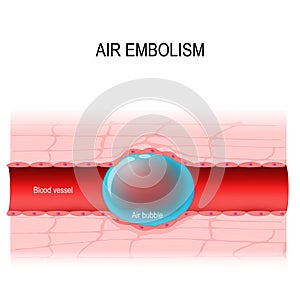 Air embolism is a blood vessel blockage. vector diagram