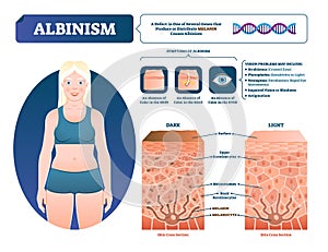 Albinism vector illustration. Labeled medical melanin pigment loss scheme.