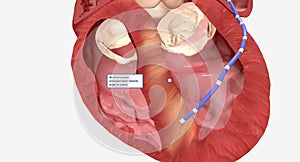 In alcohol septal ablation, a small amount of pure alcohol is released into an artery at the septum