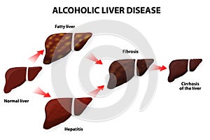 Alcoholic liver disease