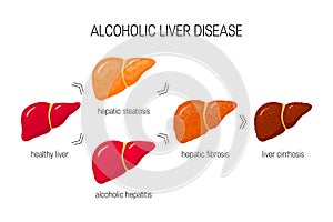 Alcoholic liver disease vector concept photo