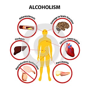 Alcoholism. infographic