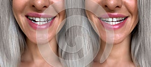 Alignment and correction of tooth defects