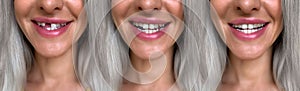 Alignment and correction of tooth defects photo