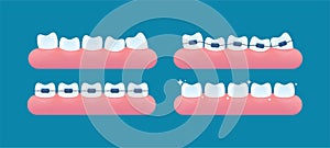 Alignment of teeth and bite correction with the help of braces system. Vector cartoon style