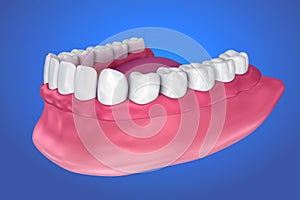 All missing teeth - removable full denture. illustration