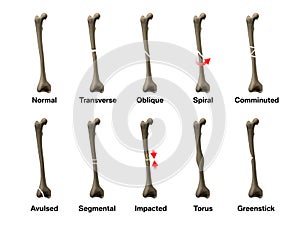 All Types of Bone Fractures photo