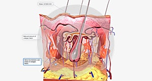 All types of EDS are caused by inherited, genetic abnormalities that affect the different genes responsible for collagen formation