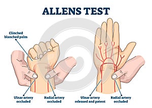 Allens test vector illustration. Physical arterial blood examination scheme